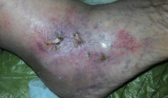 Complicacións de varices