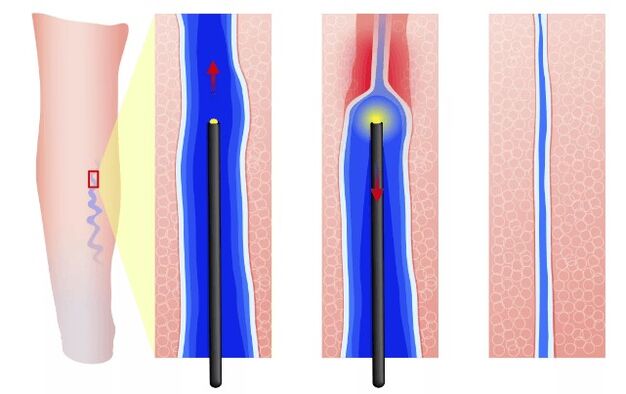 Cuboagulación eléctrica endovasal