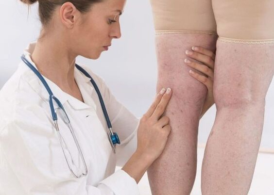 Diagnóstico de varices