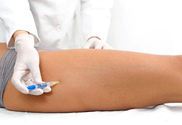 Tratamento de varices