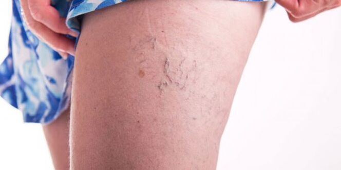 Varices na perna