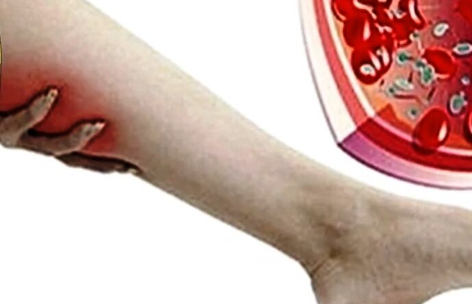 Varices na perna
