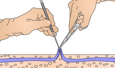 Operación para varices