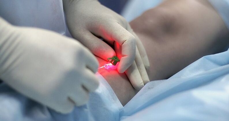 Tratamento cirúrxico das varices